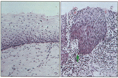 Invasive carcinoma of the uterine cervix